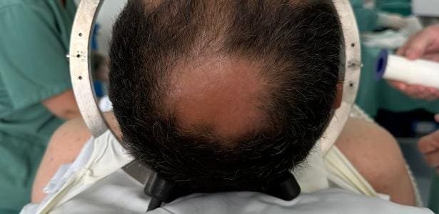 Implante cerebral transforma pensamentos em fala quase em tempo real