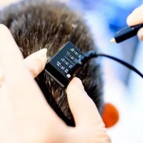 Implante no cérebro permite mulher ‘falar’ com seus pensamentos