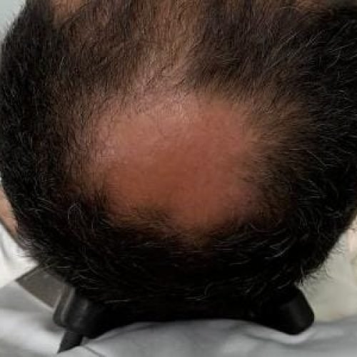 Implante cerebral transforma pensamentos em fala quase em tempo real